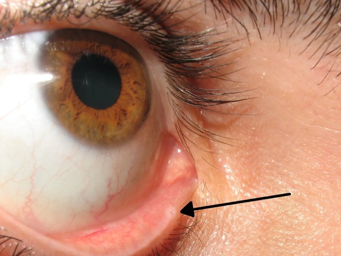 Lt-f12 giant eye with eyelid and lacrimal system